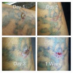 tattoo blister 1 week 250x250 1 - medical cosmetic