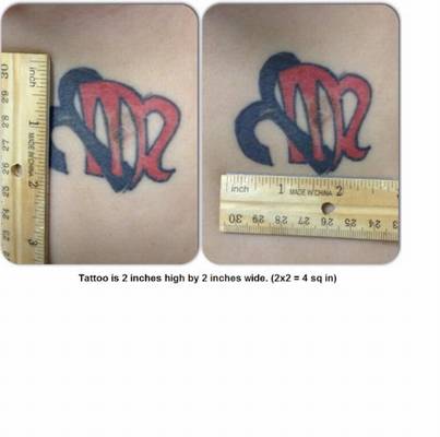 Laser Tattoo removal , Medical Cosmetic in Washington DC near Dupont Circle, Georgetown serving Arlington Virginia and Maryland