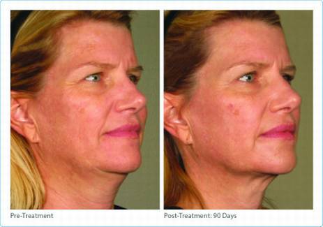 Ultherapy, HIFU, softwave non skin tightening, under eyes, see us Medical Cosmetic in Georgetown, Dupont circle, Bethesda Maryland, Arlington Virginia, washington dc