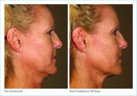 Ultherapy, HIFU, softwave non skin tightening, under eyes, see us Medical Cosmetic in Georgetown, Dupont circle, Bethesda Maryland, Arlington Virginia, washington dc